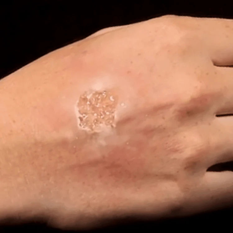 Blister gel, Rakkulageeli,  60 ml Grimas